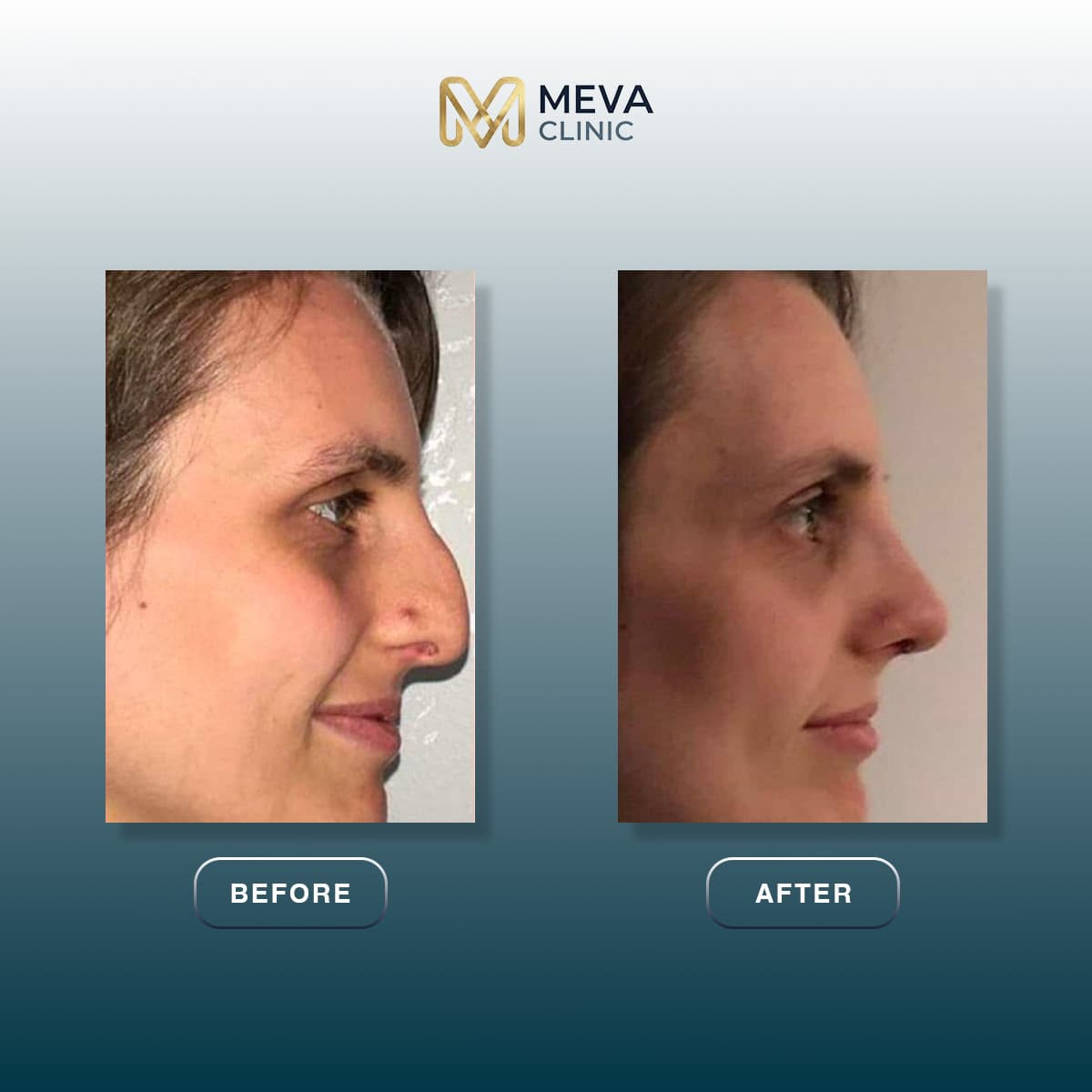 Rezultate Rinoplastie Ultrasonică Piezo - Cazul 24