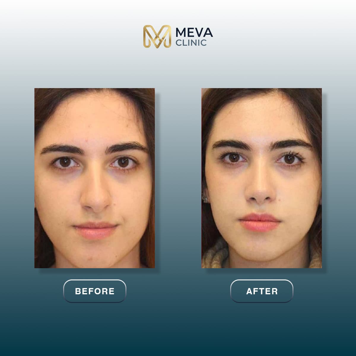Rezultate Rinoplastie Ultrasonică Piezo - Cazul 25