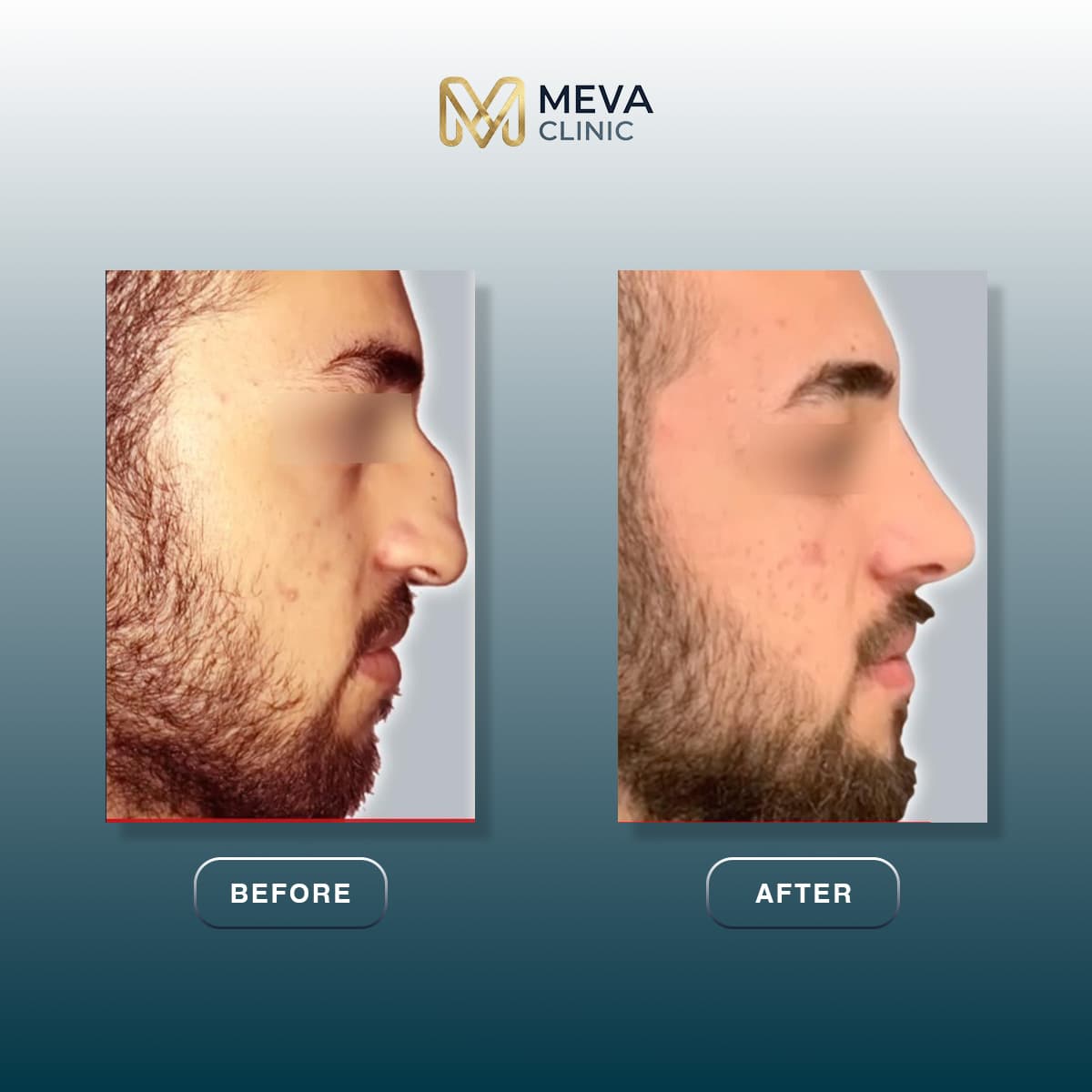Rezultate Rinoplastie Ultrasonică Piezo - Cazul 27
