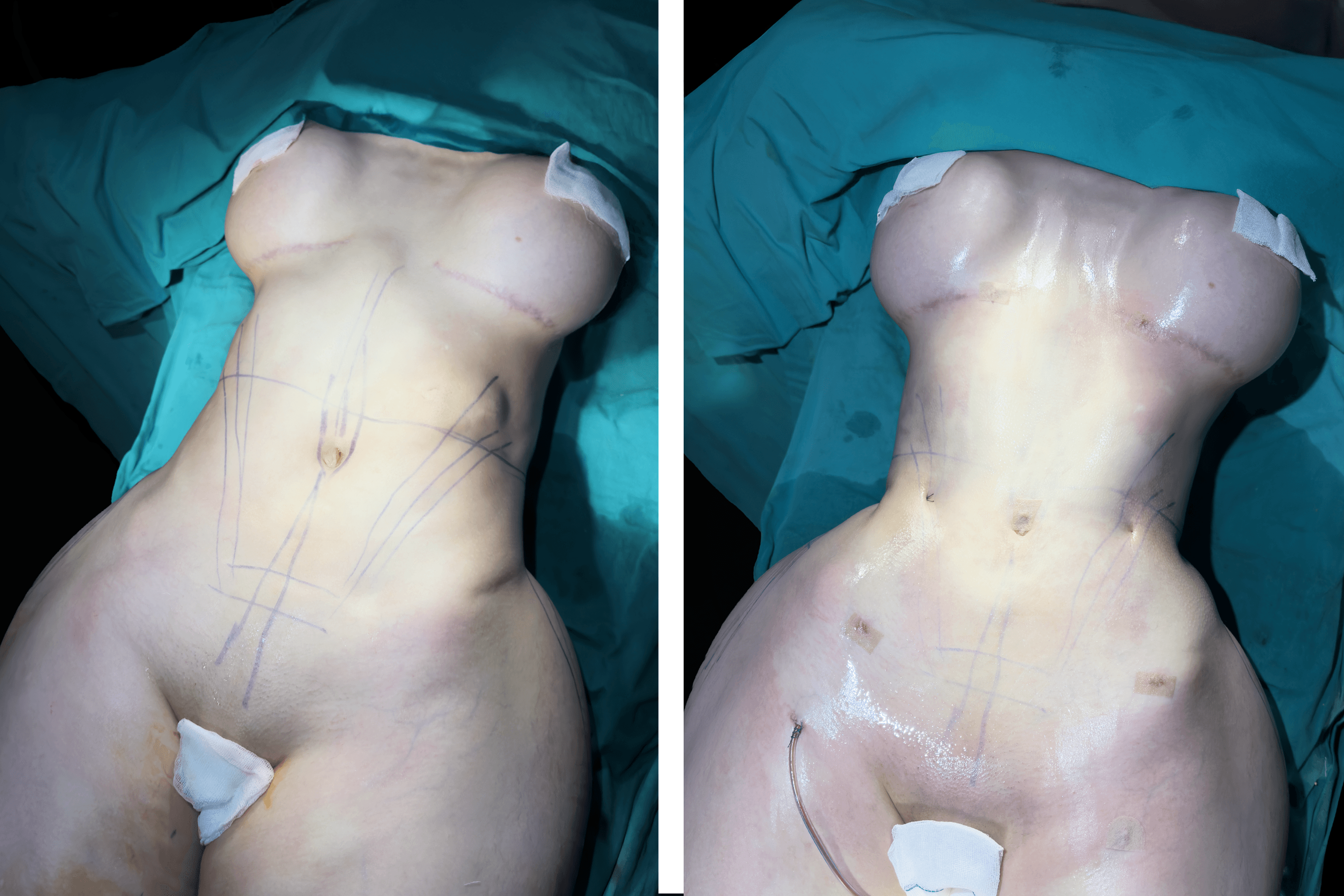 Risultati Liposuzione Vaser (High-Def) - Caso 2