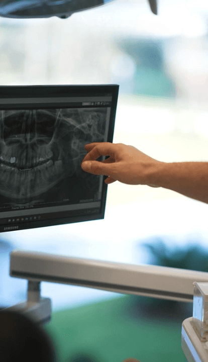 Zirconium Veneers & Crowns - Case 17