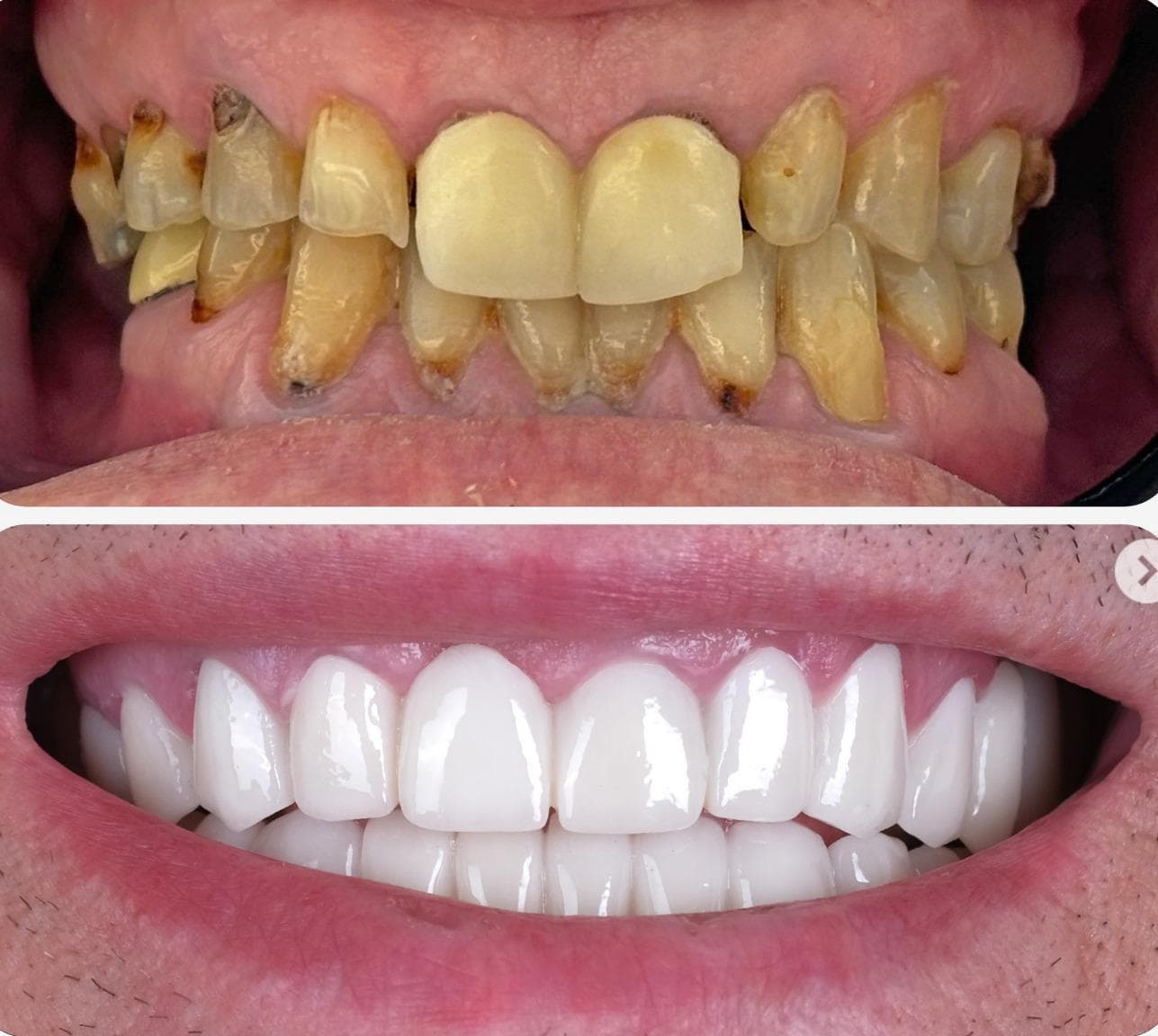 Zirconium Veneers & Crowns - Case 25