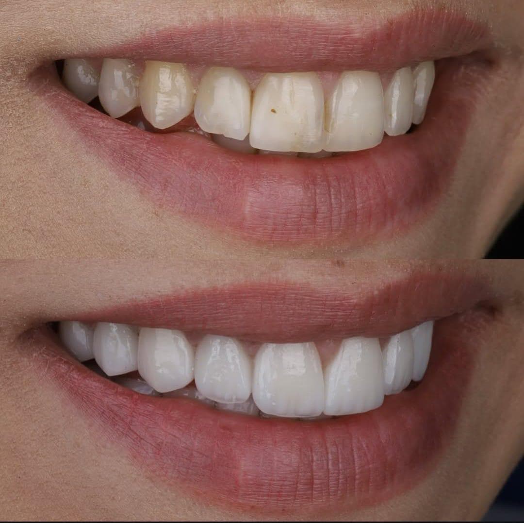 Zirconium Veneers & Crowns - Case 37