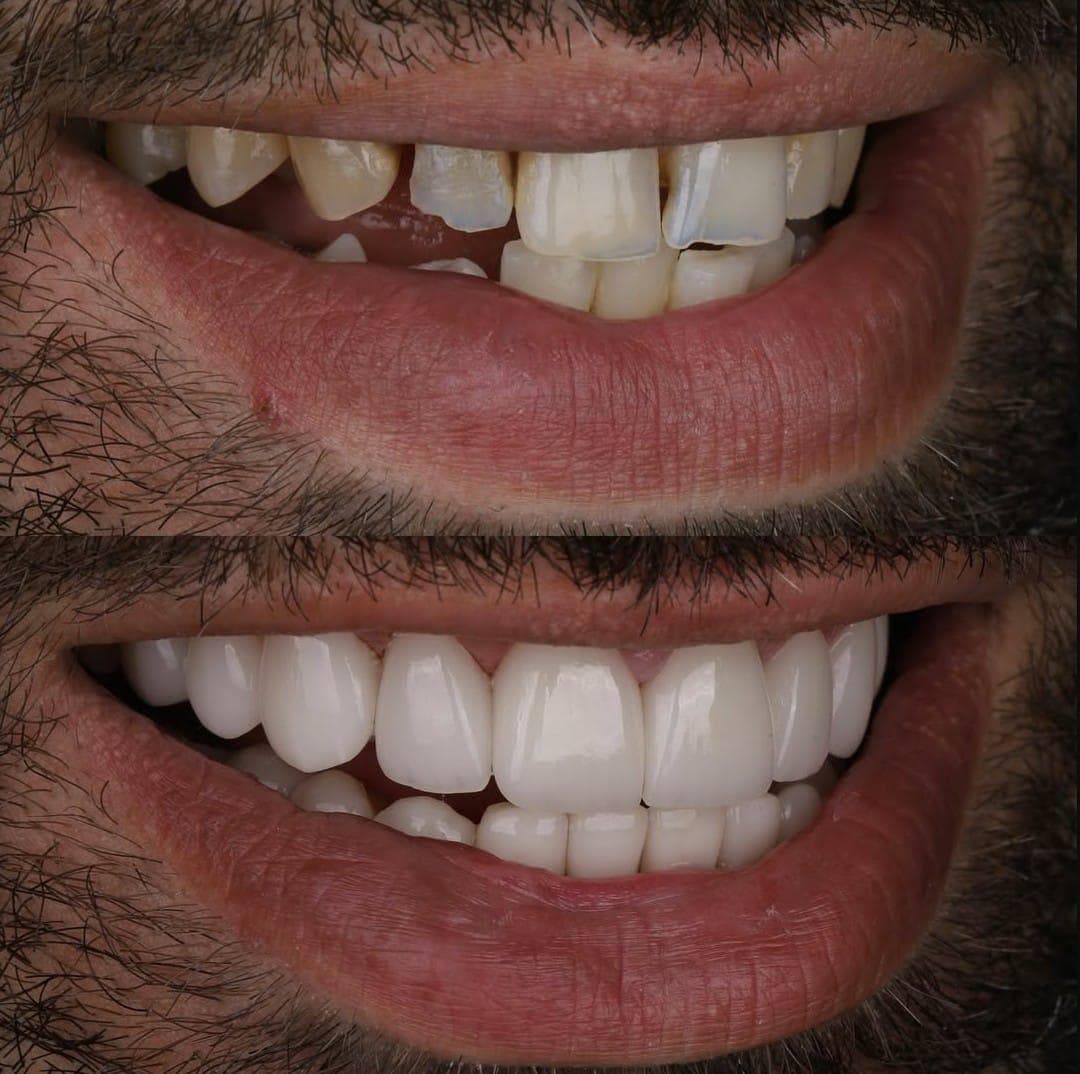 Zirconium Veneers & Crowns - Case 38