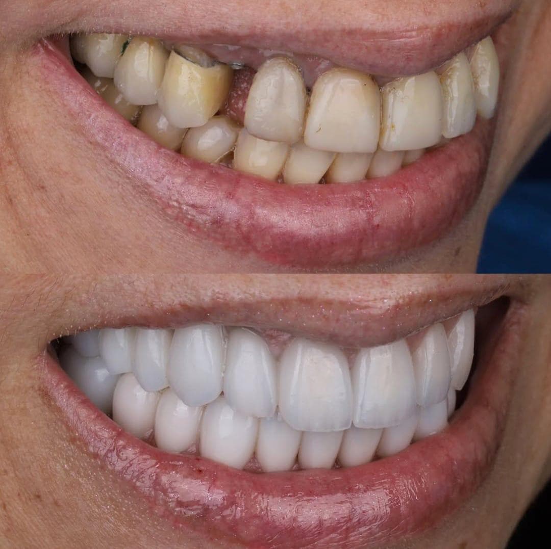 Zirconium Veneers & Crowns - Case 45
