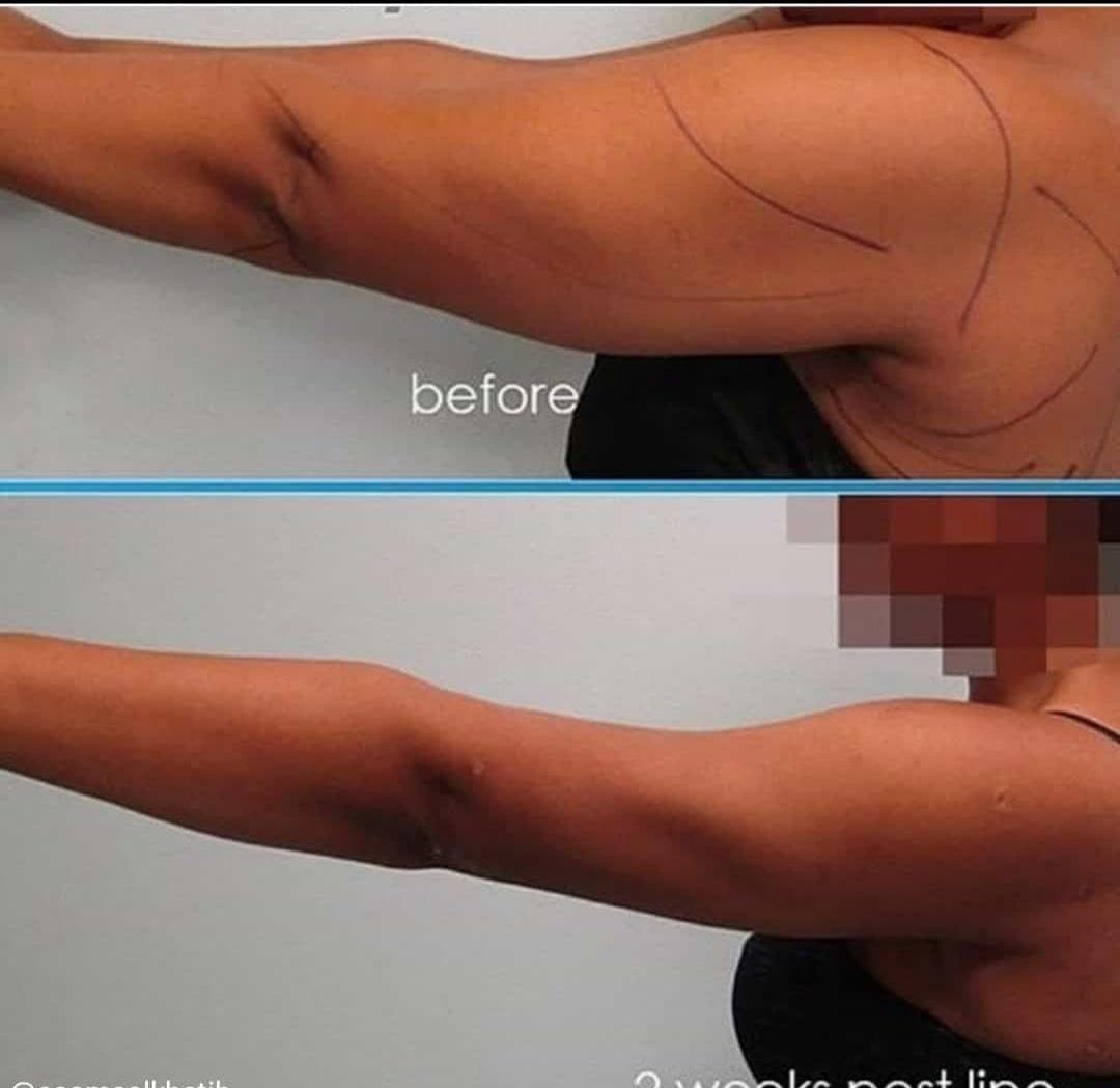 Ergebnisse Arm- und Oberschenkelstraffung - Fall 1