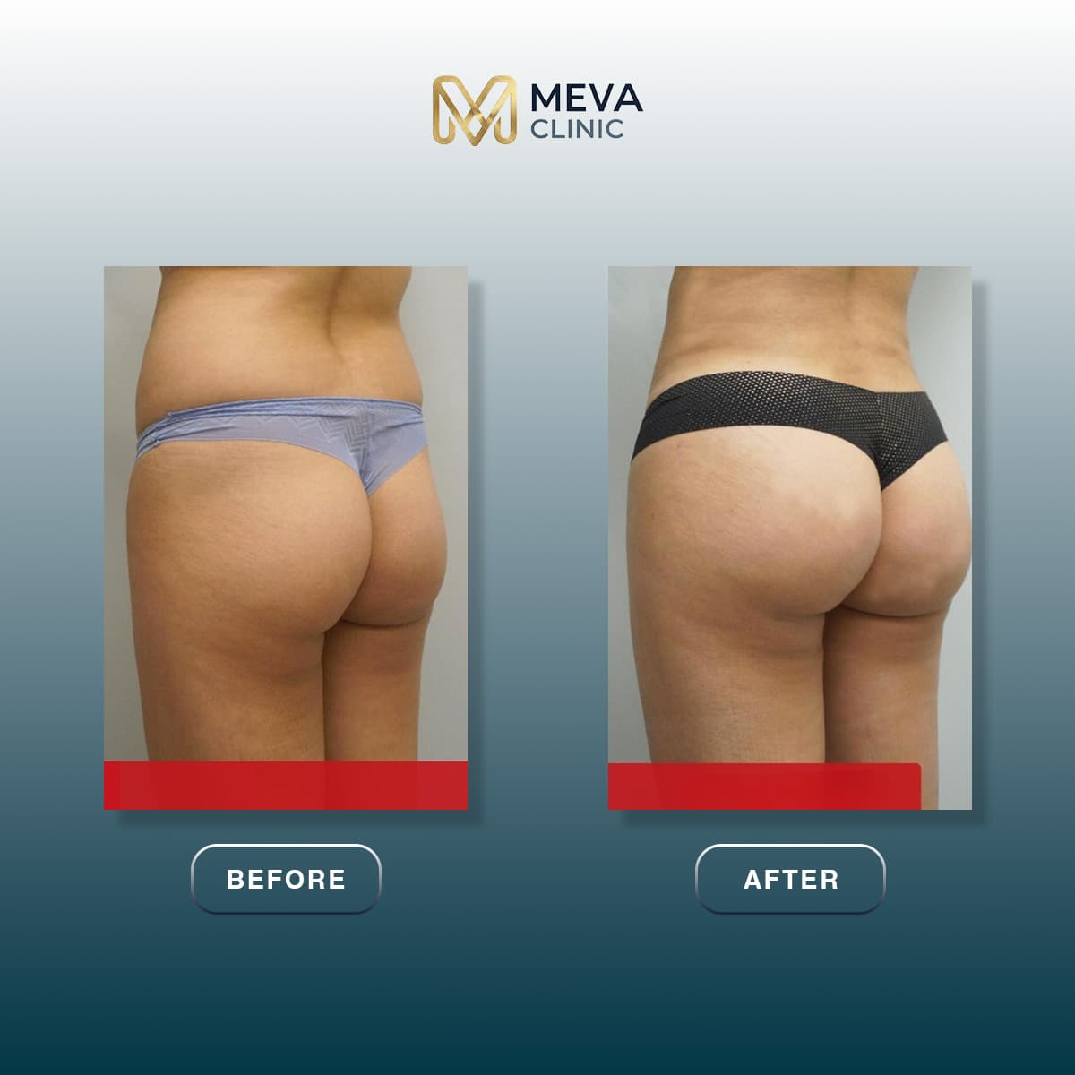 Ergebnisse BBL (Brazilian Butt Lift) - Fall 1
