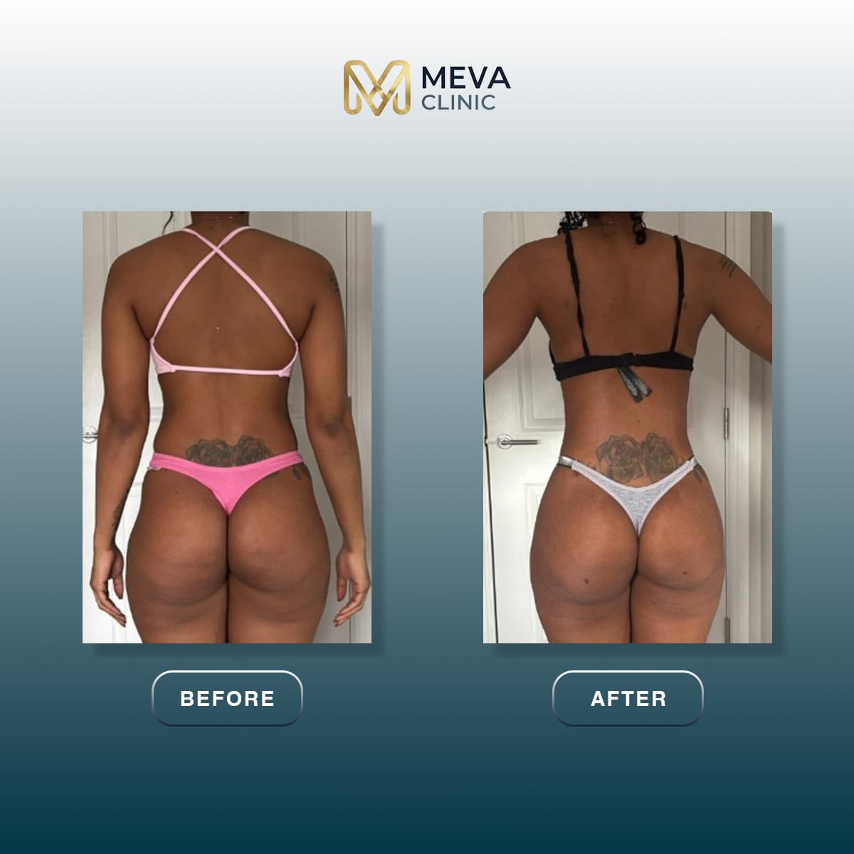 Ergebnisse BBL (Brazilian Butt Lift) - Fall 3