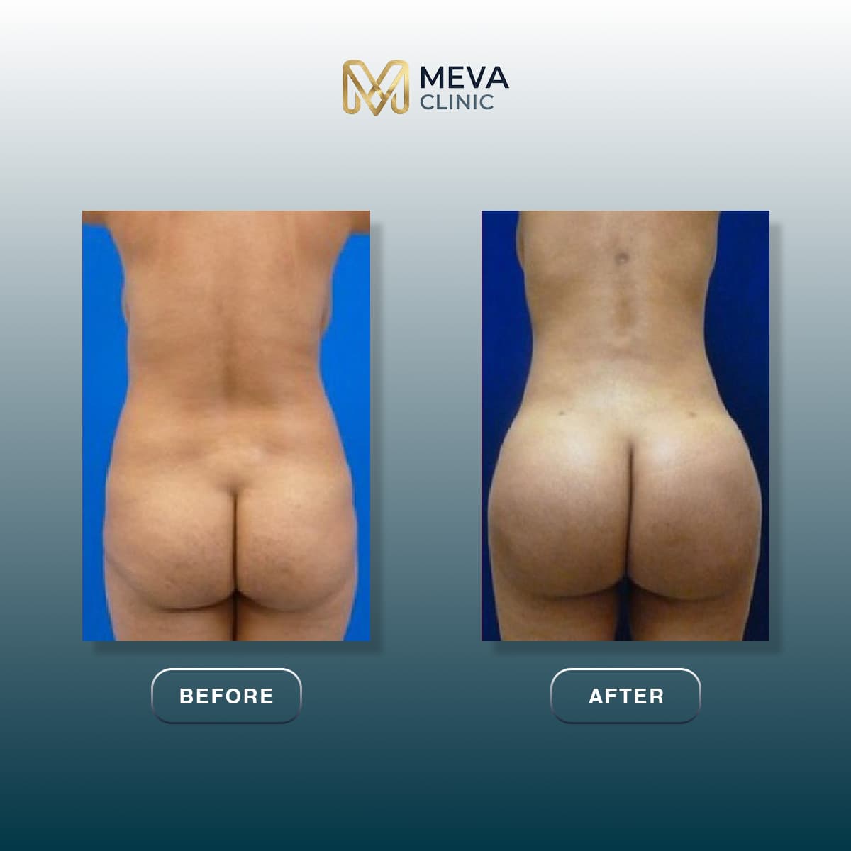 Ergebnisse BBL (Brazilian Butt Lift) - Fall 10
