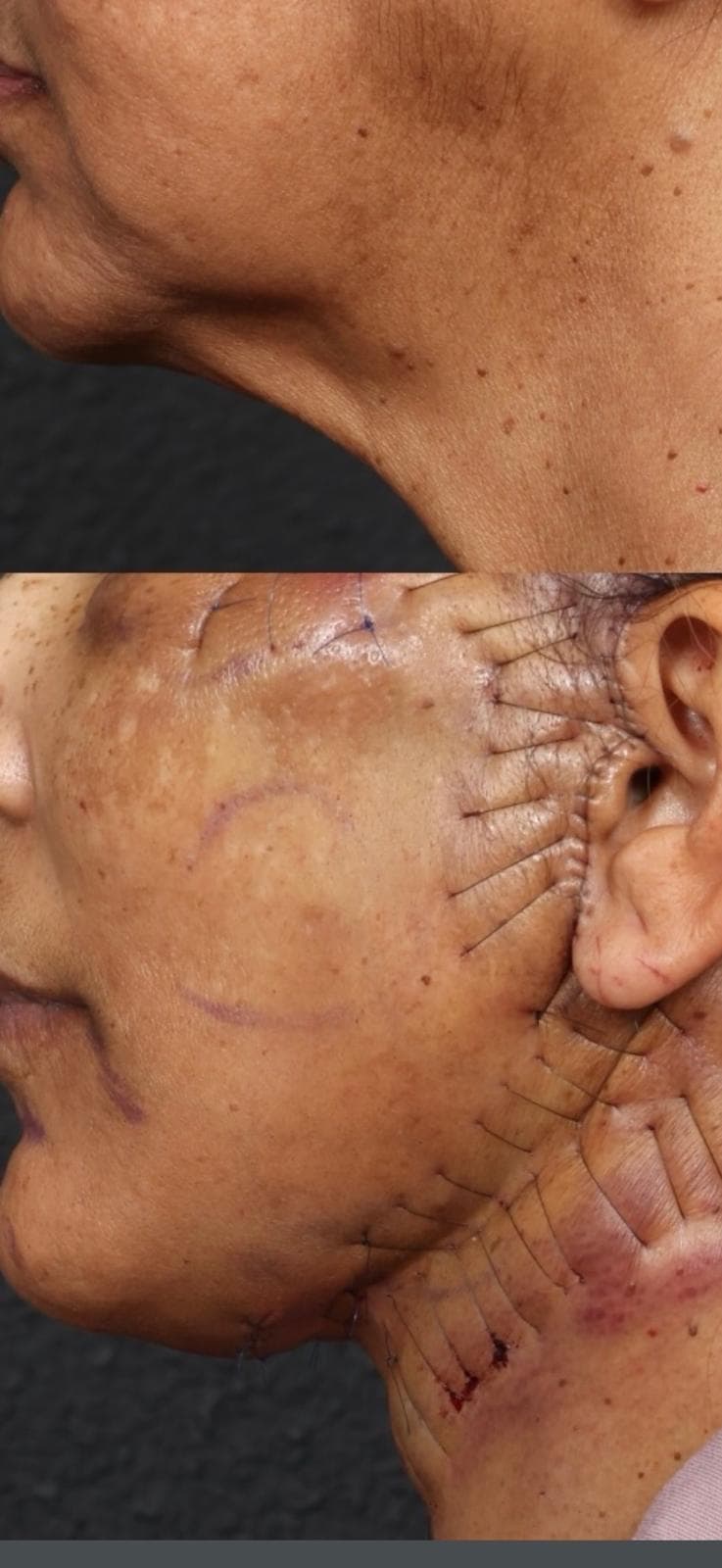 Risultati Lifting Facciale Deep Plane - Caso 12
