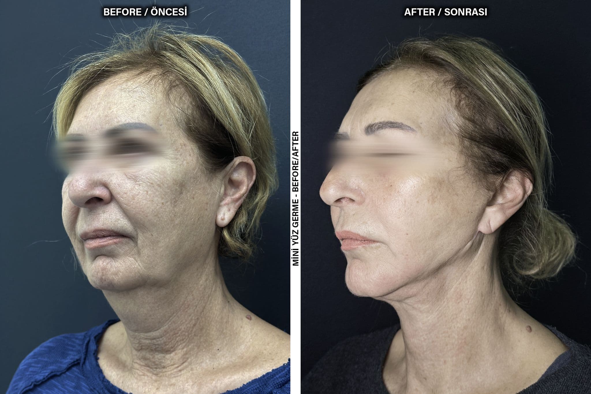 Risultati Lifting Facciale Deep Plane - Caso 13