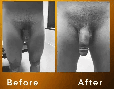 Rezultate Alungire Penis (Ligamentoliză) - Cazul 7